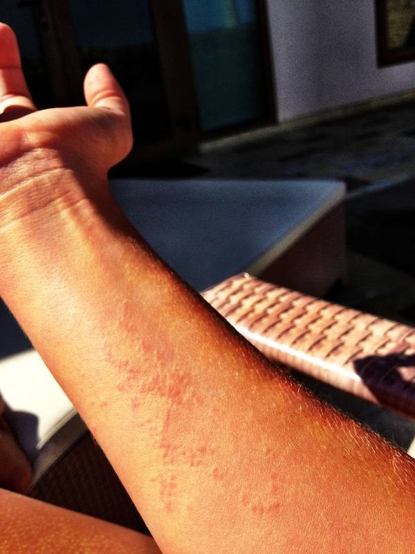 Jelly Sting on an arm.
